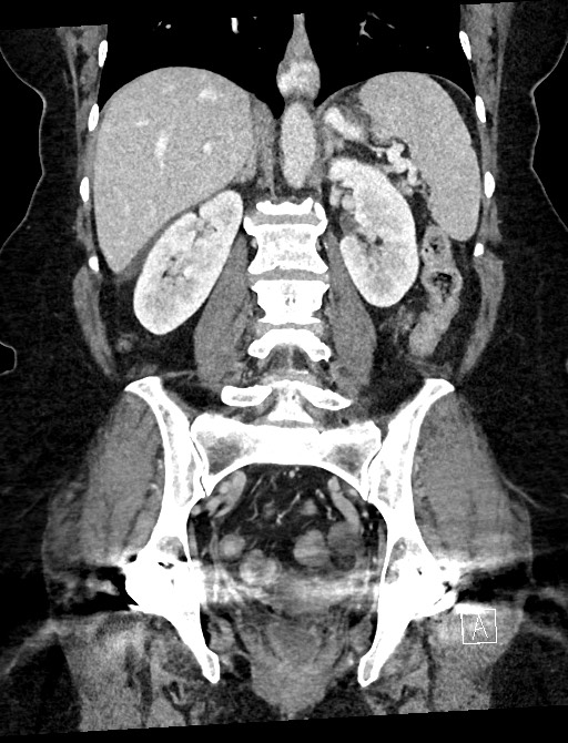Closed loop small bowel obstruction - adhesions (Radiopaedia 59078-66369 B 78).jpg