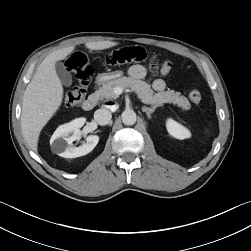 Closed loop small bowel obstruction - internal hernia (Radiopaedia 57806-64778 B 41).jpg