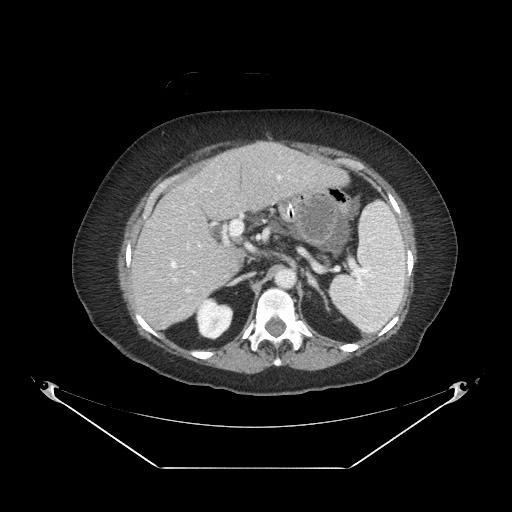 Closed loop small bowel obstruction - internal hernia (Radiopaedia 65402-74450 A 31).jpg