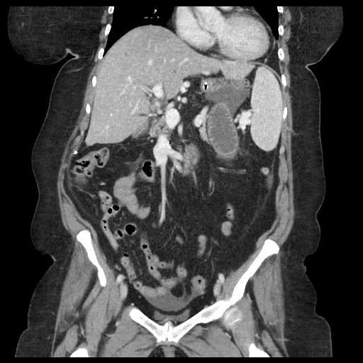 Closed loop small bowel obstruction - internal hernia (Radiopaedia 65402-74450 B 51).jpg