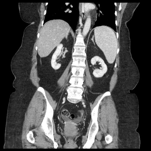 Closed loop small bowel obstruction - internal hernia (Radiopaedia 65402-74450 B 72).jpg