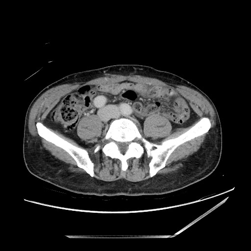 Closed loop small bowel obstruction - omental adhesion causing "internal hernia" (Radiopaedia 85129-100682 A 110).jpg