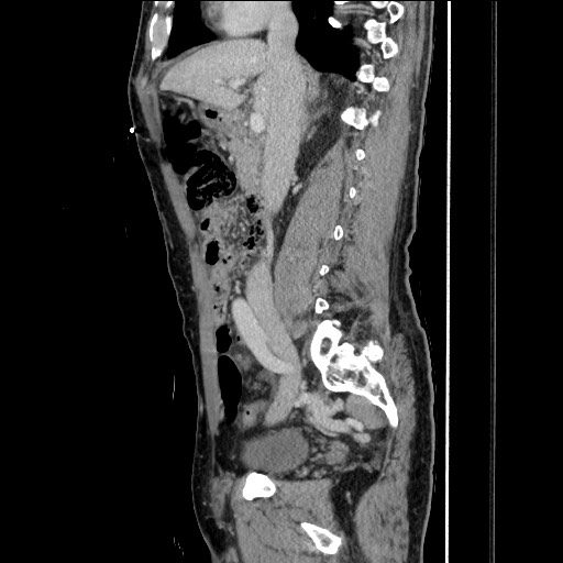 File:Closed loop small bowel obstruction - omental adhesion causing "internal hernia" (Radiopaedia 85129-100682 C 79).jpg