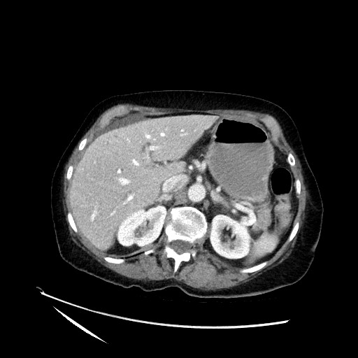 File:Closed loop small bowel obstruction due to adhesive band, with intramural hemorrhage and ischemia (Radiopaedia 83831-99017 Axial 81).jpg
