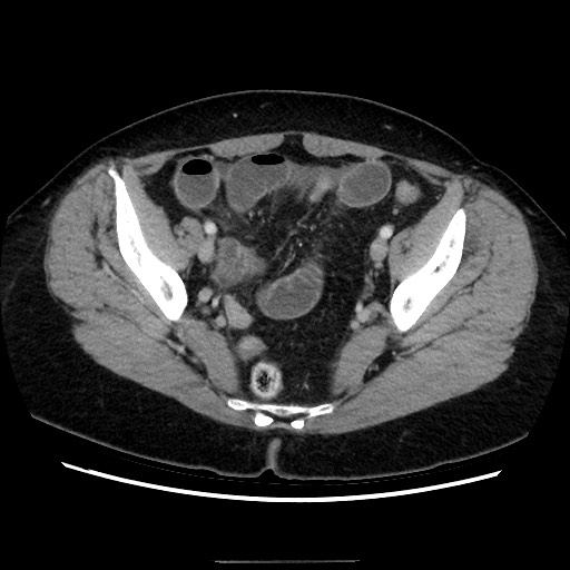 Closed loop small bowel obstruction due to adhesive bands - early and late images (Radiopaedia 83830-99015 A 138).jpg