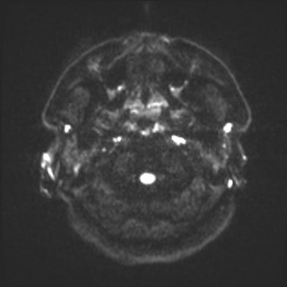 File:Cochlear incomplete partition type III associated with hypothalamic hamartoma (Radiopaedia 88756-105498 Axial DWI 41).jpg