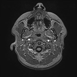File:Cochlear incomplete partition type III associated with hypothalamic hamartoma (Radiopaedia 88756-105498 Axial T1 21).jpg