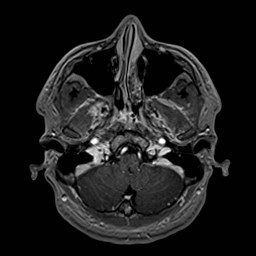 Cochlear incomplete partition type III associated with hypothalamic hamartoma (Radiopaedia 88756-105498 Axial T1 C+ 43).jpg