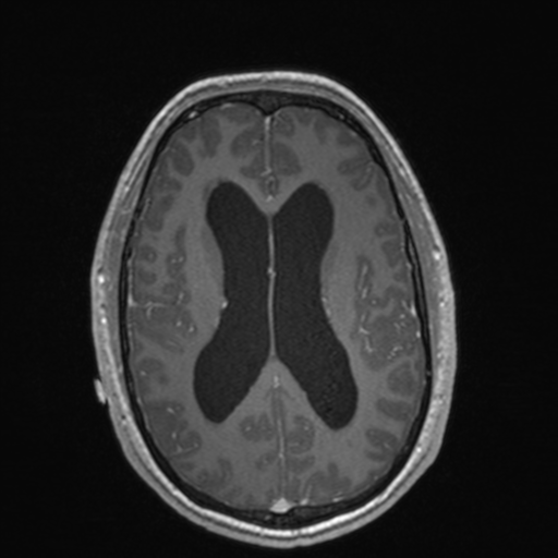 File:Colloid cyst (Radiopaedia 44510-48181 Axial T1 C+ 110).png