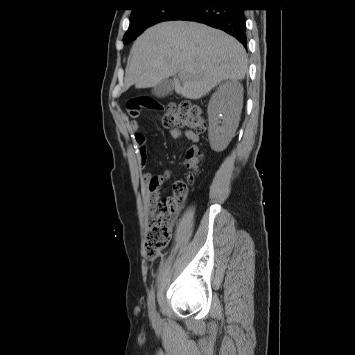 File:Colocutaneous fistula in Crohn's disease (Radiopaedia 29586-30093 C 3).jpg