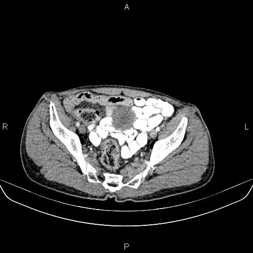 File:Colon adenocarcinoma - hepatic flexure (Radiopaedia 85635-101395 A 80).jpg