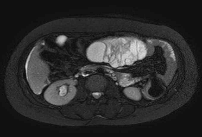 Colon adenocarcinoma with Krukenberg tumors, advanced pregnancy (Radiopaedia 67279-76645 Axial T2 SPAIR 47).jpg