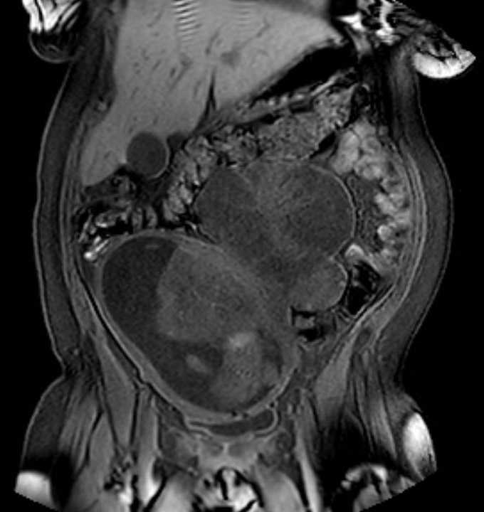 Colon adenocarcinoma with Krukenberg tumors, advanced pregnancy (Radiopaedia 67279-76645 E 27).jpg
