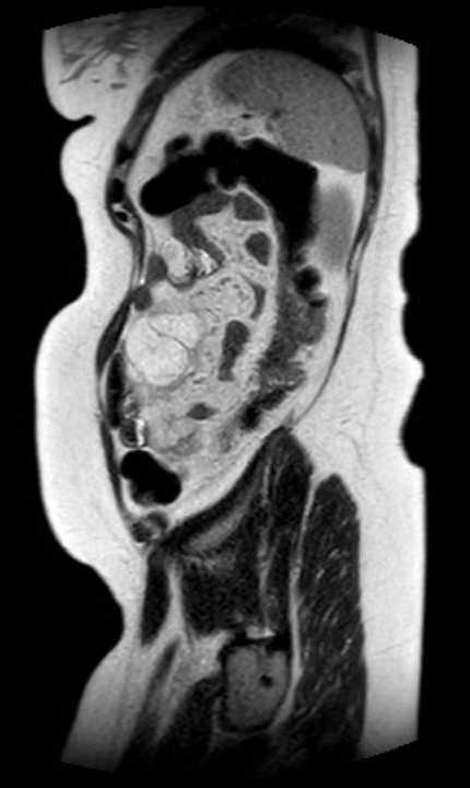 Colon adenocarcinoma with Krukenberg tumors, advanced pregnancy (Radiopaedia 67279-76645 Sagittal T2 11).jpg