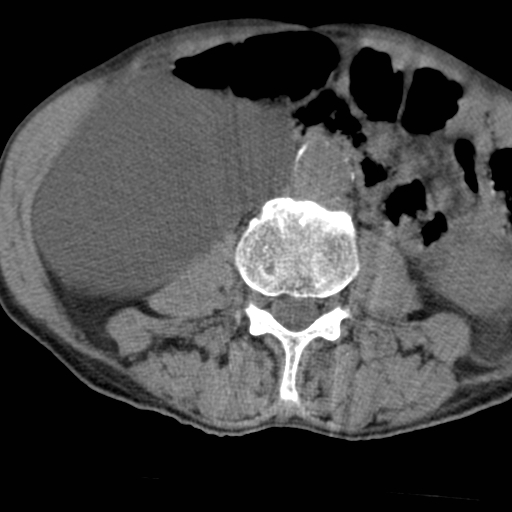 Colon cancer with calcified liver metastasis (Radiopaedia 74423-85309 Axial non-contrast 53).jpg