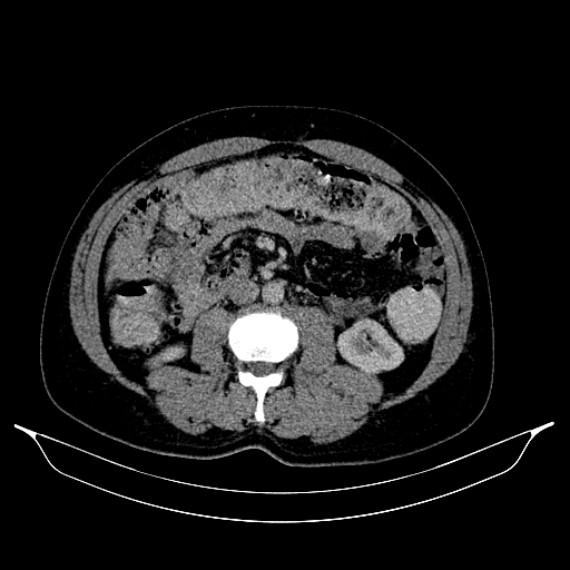 Colonic diverticulosis (Radiopaedia 72222-82744 A 11).jpg