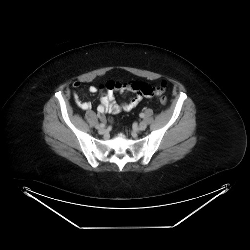 File:Colonic intussusception due to adenocarcinoma (Radiopaedia 86828-102987 A 115).jpg