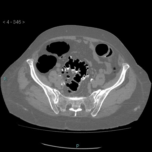 Colonic lipomas (Radiopaedia 49137-54244 Axial bone window 154).jpg
