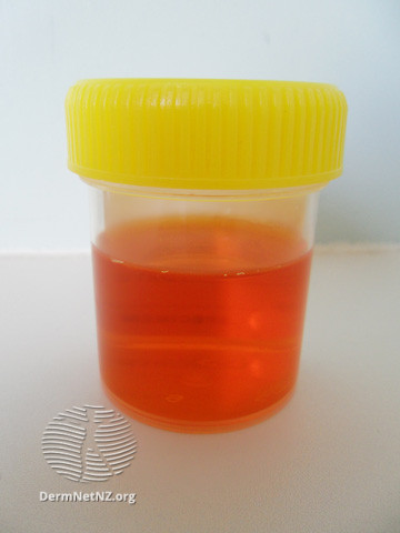 File:Discoloured urine on rifampicin (DermNet NZ treatments-rifampicin-urine).jpg