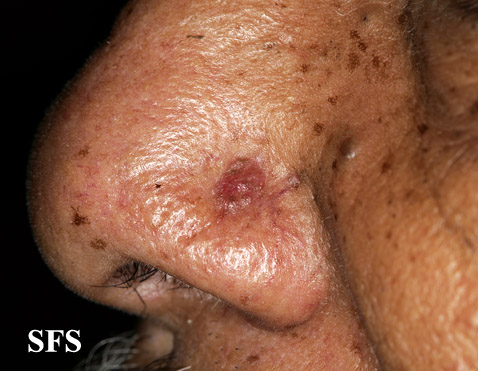 File:Melanoma (Dermatology Atlas 27).jpg