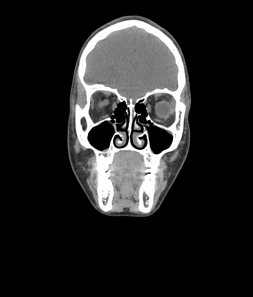 File:Nasal pyogenic granuloma (lobular capillary hemangioma) (Radiopaedia 85536-101244 Coronal non-contrast 76).jpg
