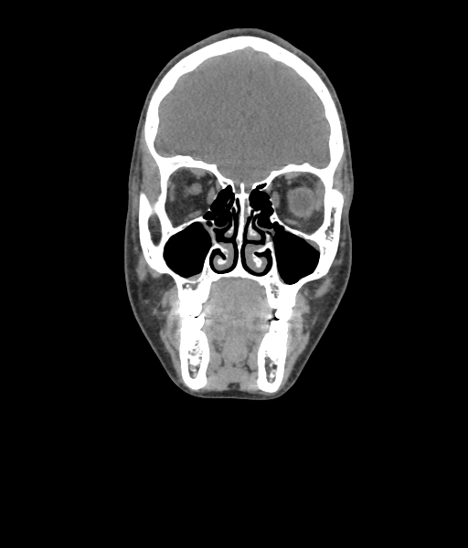 Nasal pyogenic granuloma (lobular capillary hemangioma) (Radiopaedia 85536-101244 Coronal non-contrast 77).jpg