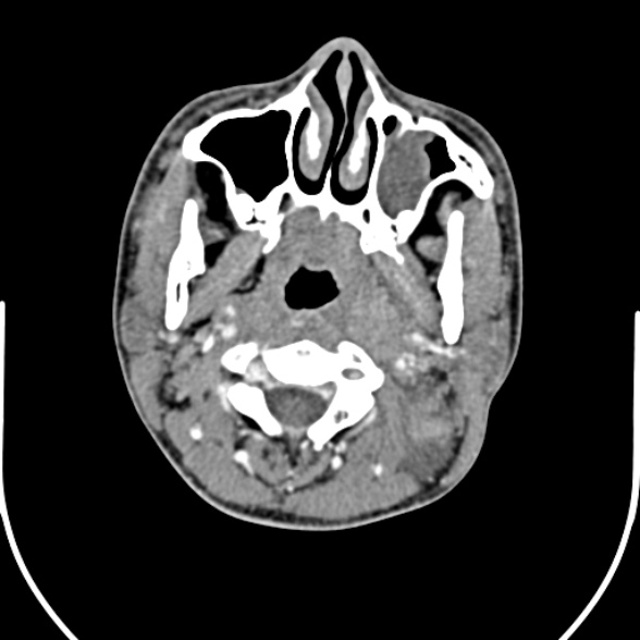 Nasopharyngeal carcinoma with skull base invasion (Radiopaedia 53415-59705 A 69).jpg