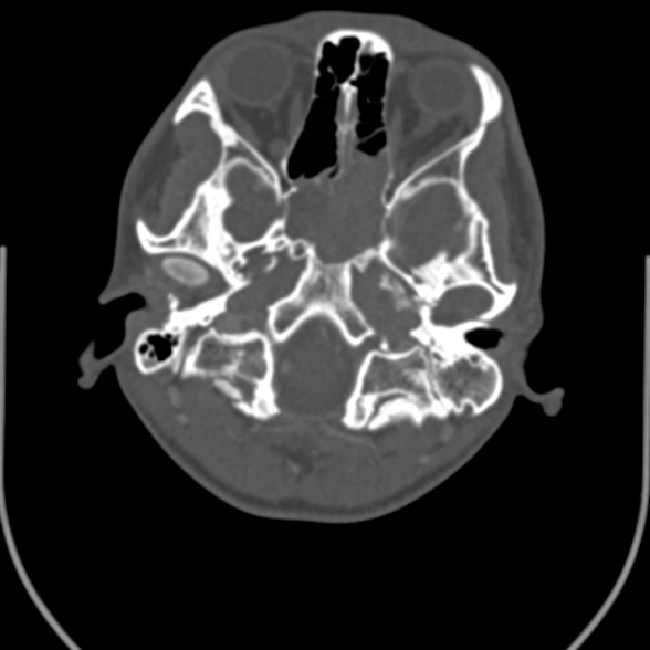 File:Nasopharyngeal carcinoma with skull base invasion (Radiopaedia 53415-59705 Axial bone window 23).jpg