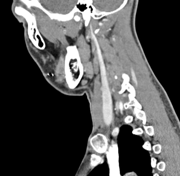 File:Nasopharyngeal carcinoma with skull base invasion (Radiopaedia 53415-59705 C 18).jpg
