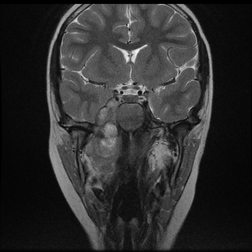 File:Nasopharyngeal rhabdomyosarcoma (Radiopaedia 23417-23486 Coronal T2 1).jpg