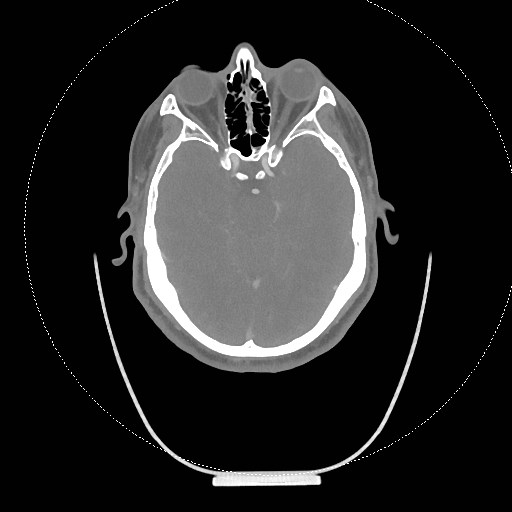 Neck CT angiogram (intraosseous vascular access) (Radiopaedia 55481-61945 B 292).jpg