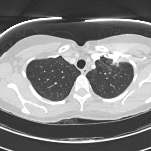 Necrobiotic pulmonary nodules - Crohn disease (Radiopaedia 20723-20631 Axial lung window 26).jpg