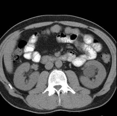 File:Necrotizing pancreatitis with acute necrotic collection (Radiopaedia 14470-14417 Axial non-contrast 22).jpg