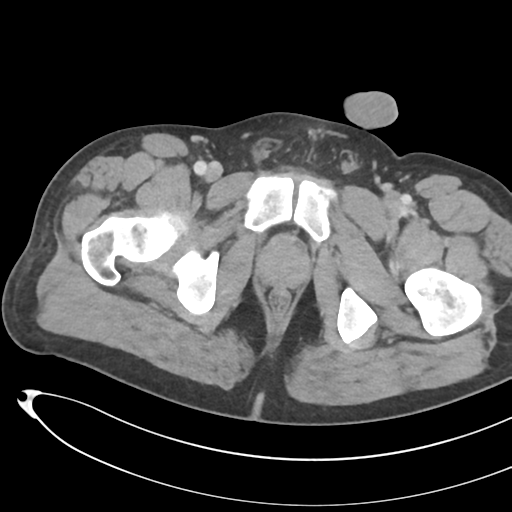 File:Necrotizing pancreatitis with acute necrotic collections (Radiopaedia 38829-41012 B 87).png