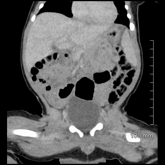 File:Neonatal neuroblastoma (Radiopaedia 56651-63438 Coronal non-contrast 23).jpg