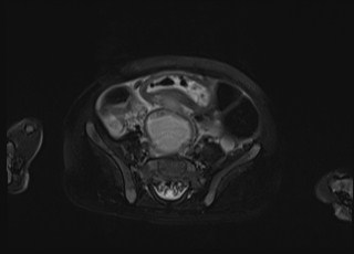 Neonatal prostatic utricle abscess - cyst (Radiopaedia 69511-79394 Axial T2 fat sat 30).jpg