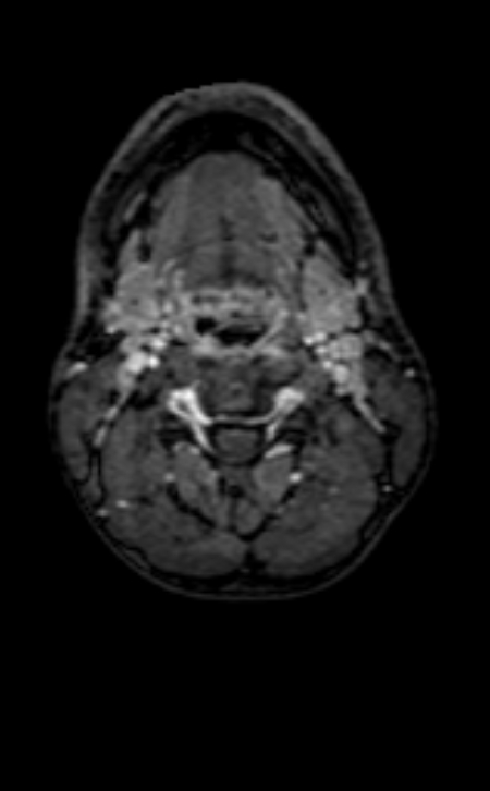 Neuro-Behçet disease (Radiopaedia 90112-107294 Axial T1 C+ 256).jpg