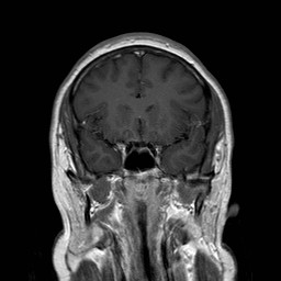 File:Neuro-Behcet's disease (Radiopaedia 21557-21505 Coronal T1 C+ 6).jpg