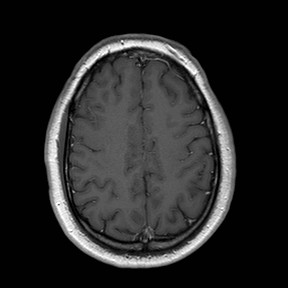 File:Neuro-Behcet's disease (Radiopaedia 21557-21506 Axial T1 C+ 21).jpg