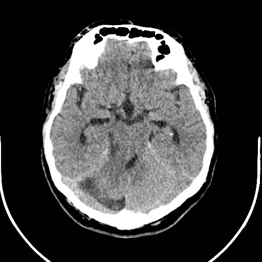 Neurofibromatosis type 2 (Radiopaedia 79097-92047 Axial non-contrast 22).jpg