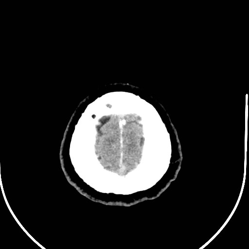 Neurofibromatosis type 2 (Radiopaedia 79097-92047 Axial non-contrast 58).jpg