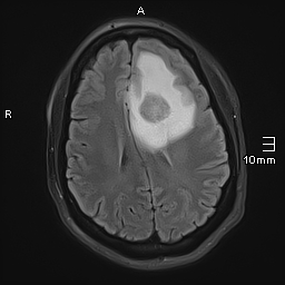 File:Neurotoxoplasmosis - concentric target sign (Radiopaedia 70644-80784 Axial FLAIR 14).jpg