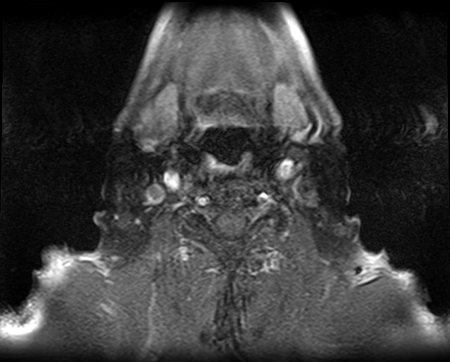 File:Non-Hodgkin lymphoma - parotid gland (Radiopaedia 71531-81890 Axial T1 C+ fat sat 4).jpg