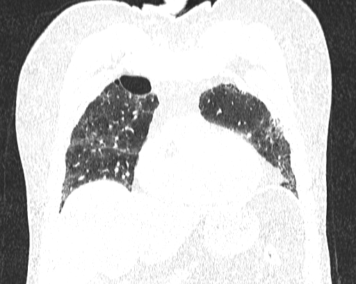 Non-specific interstitial pneumonia (NSIP) (Radiopaedia 68599-78228 Coronal lung window 23).jpg