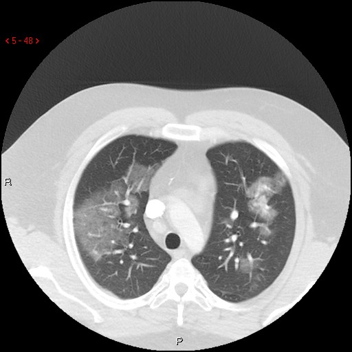 File:Non-specific interstitial pneumonitis (Radiopaedia 27044-27222 Axial lung window 39).jpg
