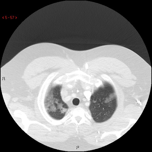 File:Non-specific interstitial pneumonitis (Radiopaedia 27044-27222 Axial lung window 48).jpg