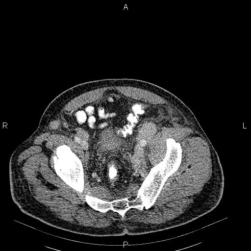 File:Non Hodgkin lymphoma in a patient with ankylosing spondylitis (Radiopaedia 84323-99621 B 57).jpg