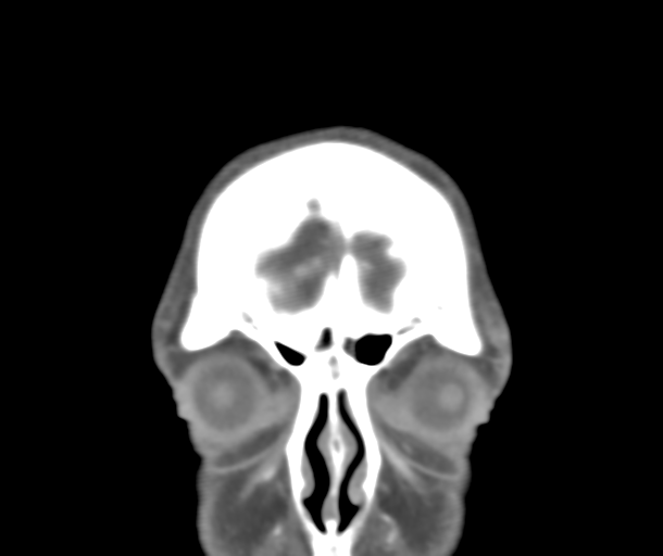 File:Normal CTA head (Radiopaedia 40801-43464 B 12).png