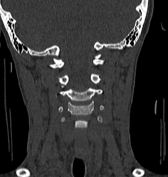 File:Normal CT cervical spine - 12-year-old (Radiopaedia 55352-61775 Coronal bone window 92).jpg