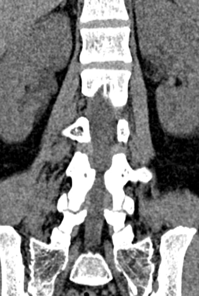 Normal CT lumbar spine (Radiopaedia 53981-60118 F 52).jpg